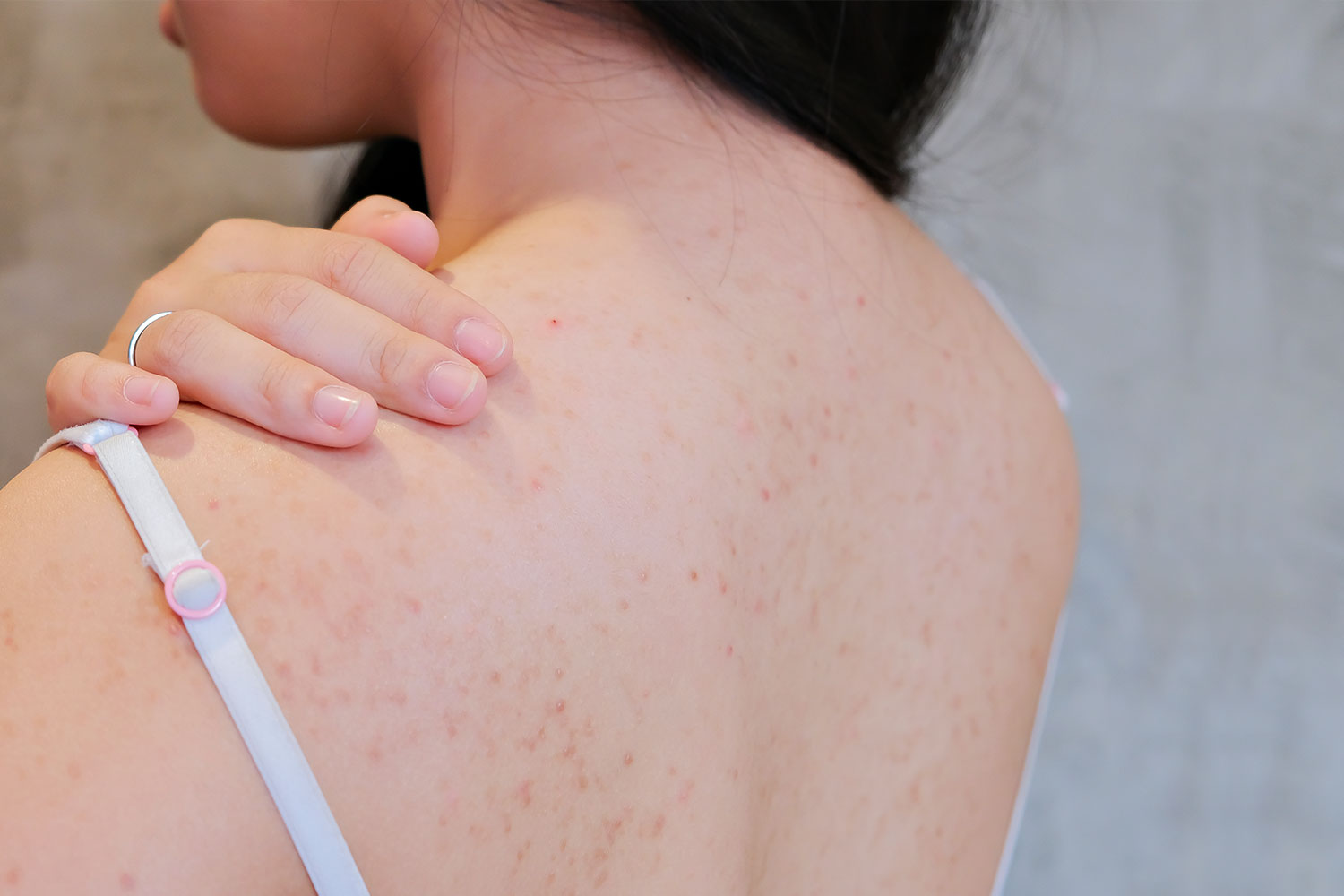 how to get rid of back acne